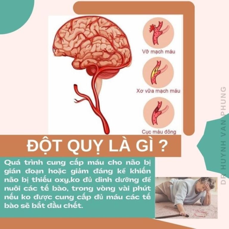 Đột quỵ còn được gọi là tai biến mạch máu não. Đây là tình trạng não bộ bị tổn thương nghiêm trọng do quá trình cấp máu não bị gián đoạn