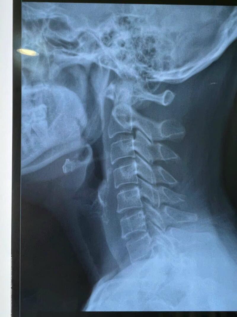 đau đầu căng cơ