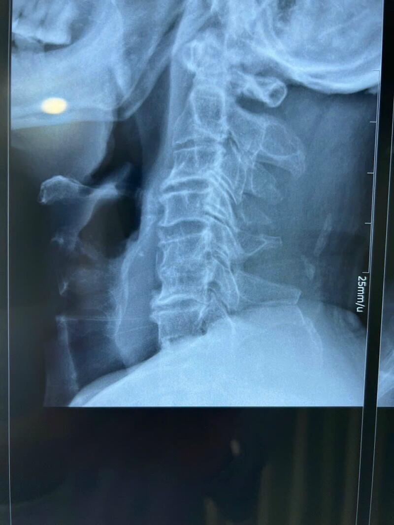 đau đầu căng cơ